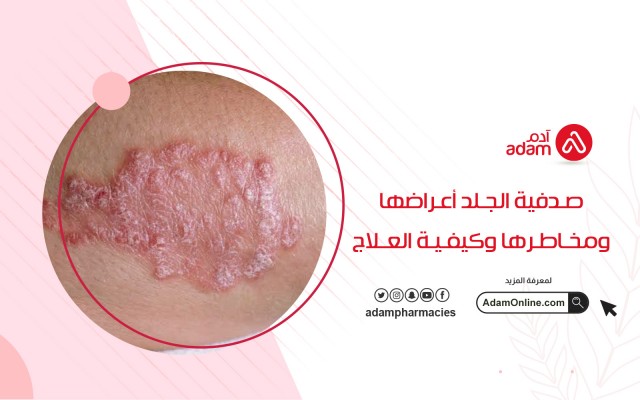 صدفية الجلد أعراضها ومخاطرها وكيفية العلاج